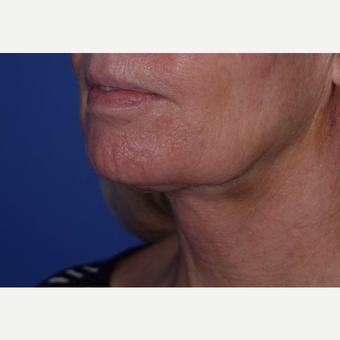 55-64 year old woman treated with laser-assisted Neck Lift after 3638979