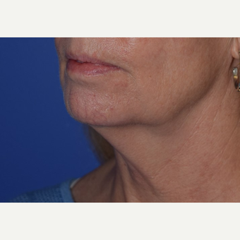 55-64 year old woman treated with laser-assisted Neck Lift before 3638979