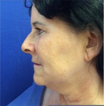 45-54 year old woman treated with Facelift 3191423