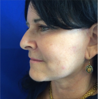 45-54 year old woman treated with Facelift 3191423
