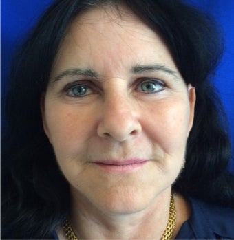 45-54 year old woman treated with Facelift after 3191423