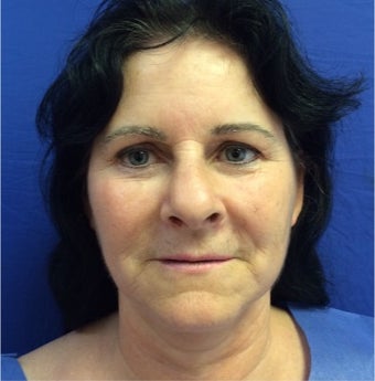 45-54 year old woman treated with Facelift before 3191423