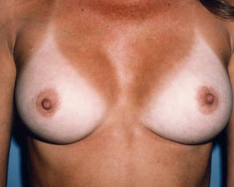 Breast Augmentation Achieves Fullness after 876548