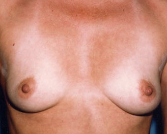 Breast Augmentation Achieves Fullness before 876548