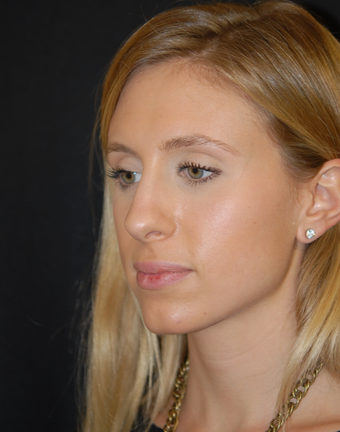 18-24 year old woman treated with Non Surgical Nose Job 1782700