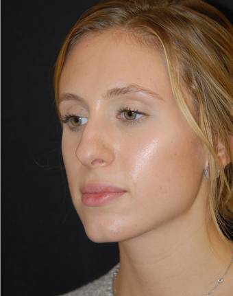 18-24 year old woman treated with Non Surgical Nose Job 1782700