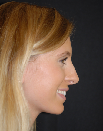 18-24 year old woman treated with Non Surgical Nose Job after 1782700