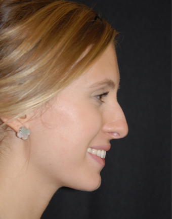 18-24 year old woman treated with Non Surgical Nose Job before 1782700