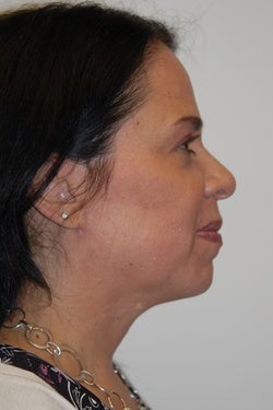 K-Lift™ Non surgical alernative for some sagging necks and faces 1098192