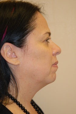 K-Lift™ Non surgical alernative for some sagging necks and faces 1098192