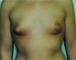 24 year old female patient before 934694
