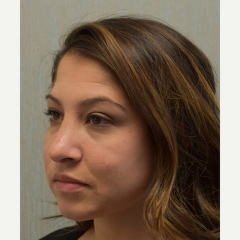 18-24 year old woman treated with Rhinoplasty after 3408537