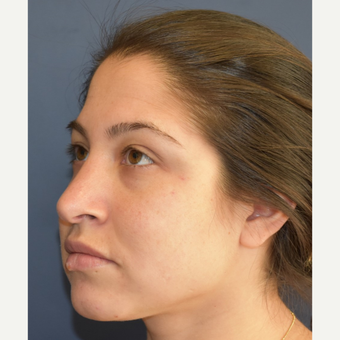 18-24 year old woman treated with Rhinoplasty before 3408537