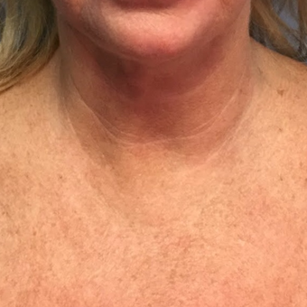 45-54 year old woman treated with Active FX before 3054382