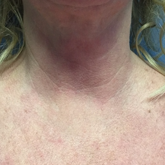 45-54 year old woman treated with Active FX after 3054382