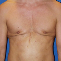 Pec Implants before 1554801