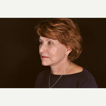 55-64 year old woman treated with Facelift after 1828717