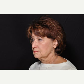 55-64 year old woman treated with Facelift before 1828717