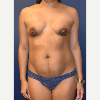 35-44 year old woman treated with Breast Lift with Implants before 3348695