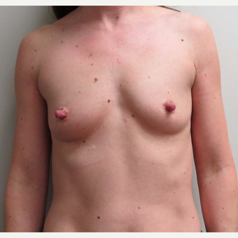 Mentor Textured Shaped Breast Implants for this 37 Year Old Woman before 2886201