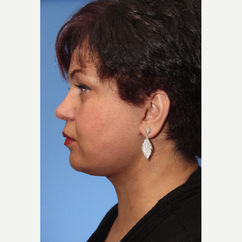 55-64 year old woman treated with Facelift after 3741331