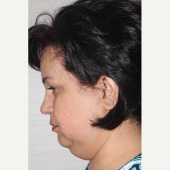 55-64 year old woman treated with Facelift before 3741331
