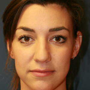 18-24 year old woman treated with Rhinoplasty before 3559771