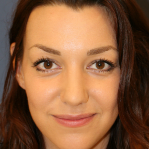 18-24 year old woman treated with Rhinoplasty after 3559771