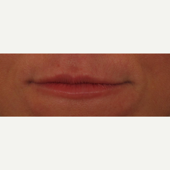 45-54 year old woman treated with Voluma for lip augmentation before 3494010