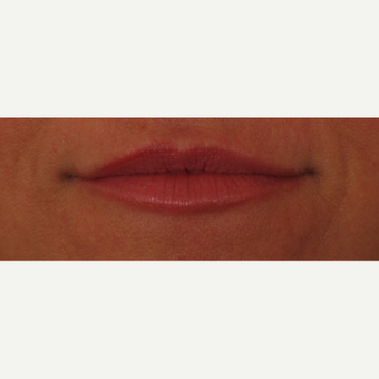45-54 year old woman treated with Voluma for lip augmentation after 3494010