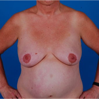 55-64 year old woman treated with Breast Augmentation before 3583327