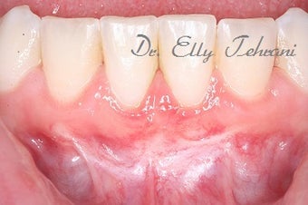 16 year old female treated with Frenectomy and Gum Graft after 1822855
