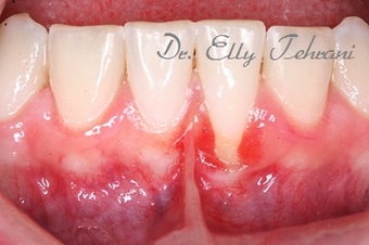 16 year old female treated with Frenectomy and Gum Graft before 1822855