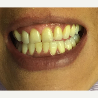 25-34 year old woman treated with Zoom Whitening before 2931251