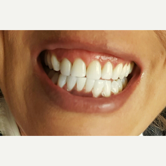 25-34 year old woman treated with Zoom Whitening after 2931251