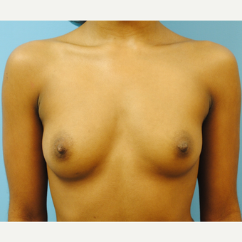 22 year old woman treated with Breast Implants, A to D cup, 5'3" 105 pounds before 3623948