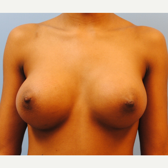 22 year old woman treated with Breast Implants, A to D cup, 5'3" 105 pounds after 3623948