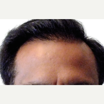 Man treated with ARTAS Robotic Hair Transplant after 1805704