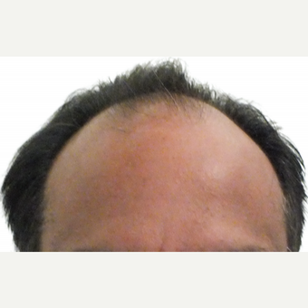 Man treated with ARTAS Robotic Hair Transplant before 1805704
