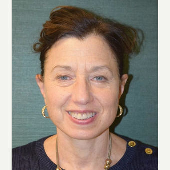 55-64 year old woman treated with Facelift after 3093037