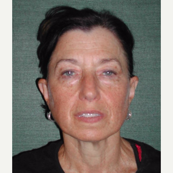 55-64 year old woman treated with Facelift before 3093037