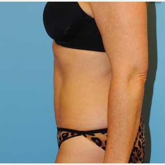 51 Year old after tummy tuck after 3135526
