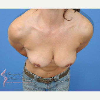 45-54 year old woman treated with Breast Fat Transfer after 2921191
