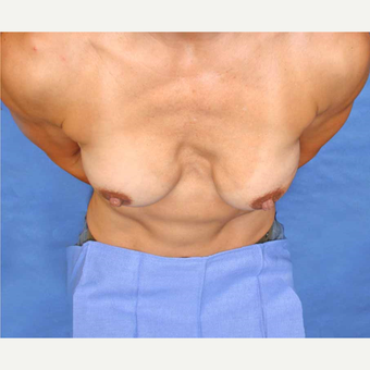 45-54 year old woman treated with Breast Fat Transfer before 2921191