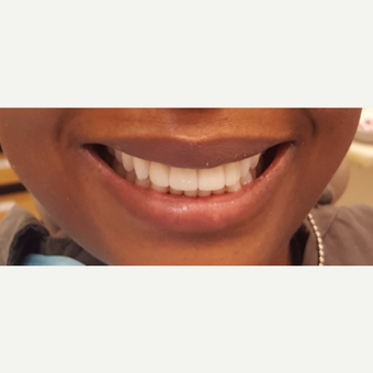 35-44 year old woman treated with Porcelain Veneers after 3306332