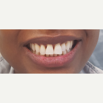 35-44 year old woman treated with Porcelain Veneers before 3306332
