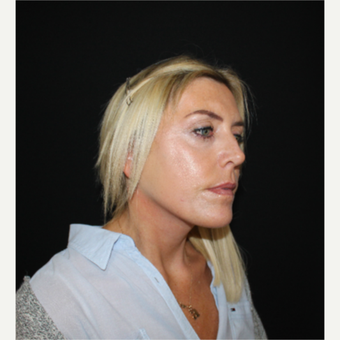 45-54 year old woman treated with SMAS Facelift after 3494000