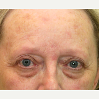 55-64 year old woman treated with Laser Resurfacing before 3295087