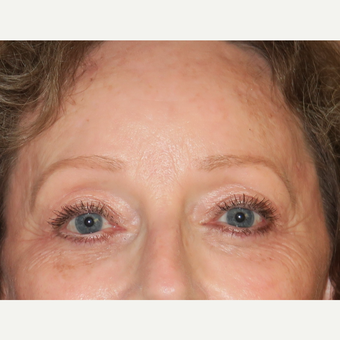 55-64 year old woman treated with Laser Resurfacing after 3295087