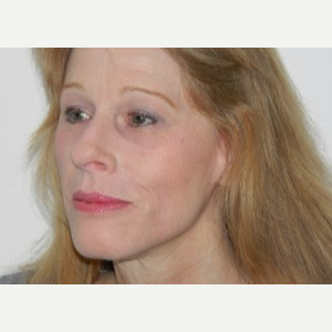 55-64 year old woman treated with Mini Lift, Browlift, 4-Lid Blepharoplasty and Fraxel after 3264694